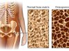 Makanan Bagi Penderita Osteoporosis